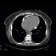 Constrictive pericarditis: CT - Computed tomography